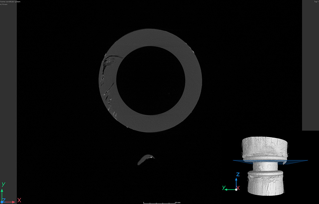 Immagine tomografica, vista dall’alto del raccordo con rottura